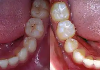 窩溝封閉、涂氟防蛀